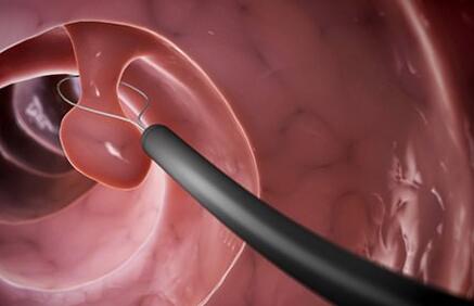 2020年的深圳第一次腸胃鏡(內(nèi)窺鏡)檢查的親身經(jīng)歷