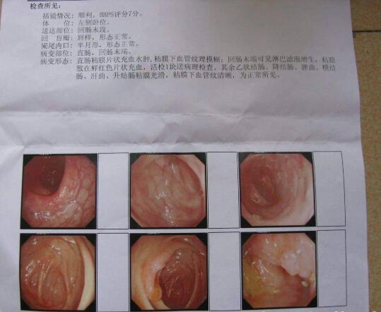 2020年的深圳第一次腸胃鏡(內(nèi)窺鏡)檢查的親身經(jīng)歷